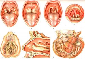 Nguyên nhân gây bệnh bạch hầu