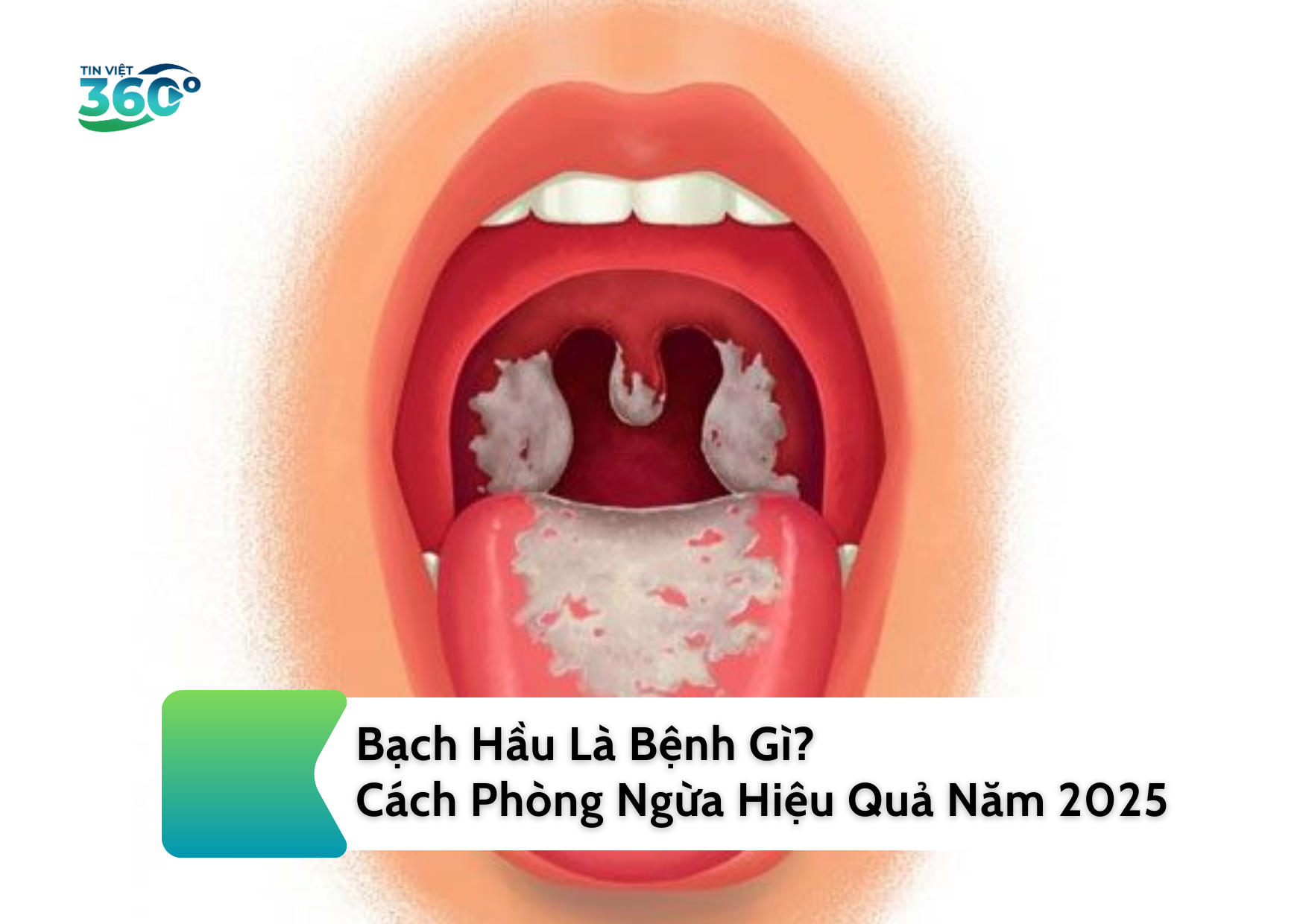 Bạch Hầu Là Bệnh Gì? Cách Phòng Ngừa Hiệu Quả Năm 2025